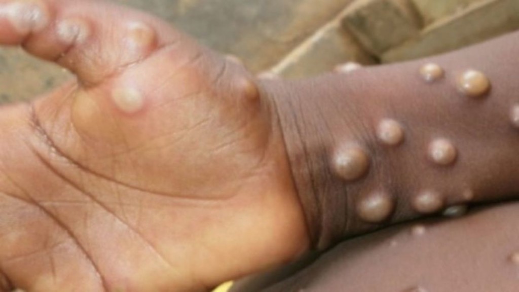 Monkeypox