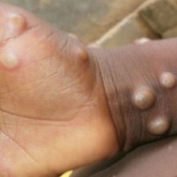 Sankuru : environ 465 cas de Monkeypox enregistrés en 5 mois