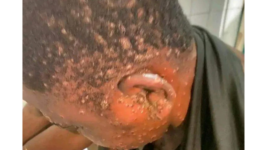 Homme atteint du Monkeypox ou variole du singe