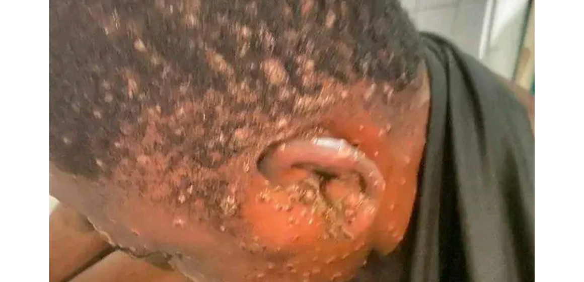 monkeypox2 Homme atteint du Monkeypox ou variole du singe