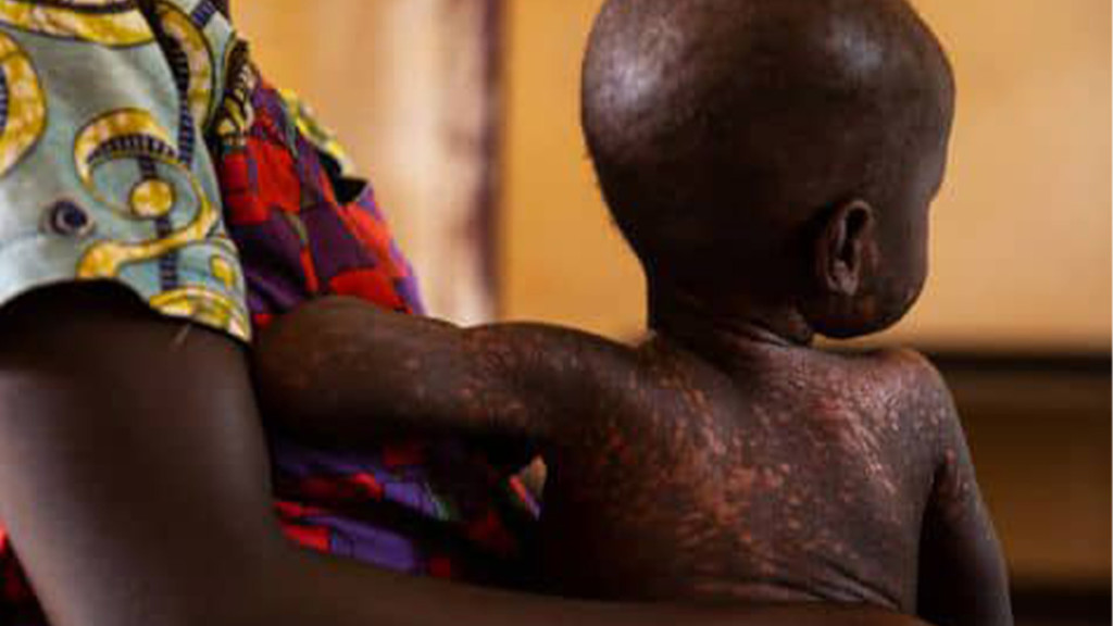 Rougeole recensée au Kasai