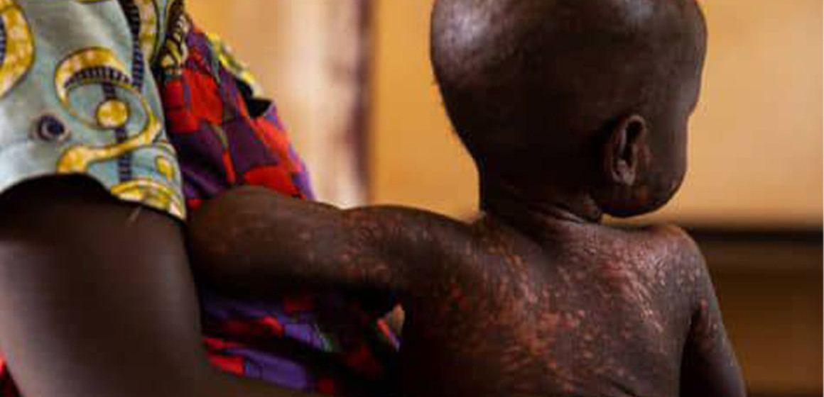 Rougeole recensée au Kasai