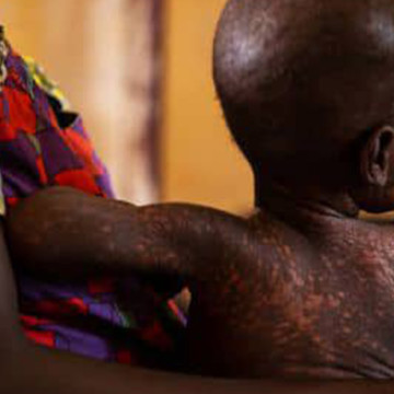 Rougeole recensée au Kasai