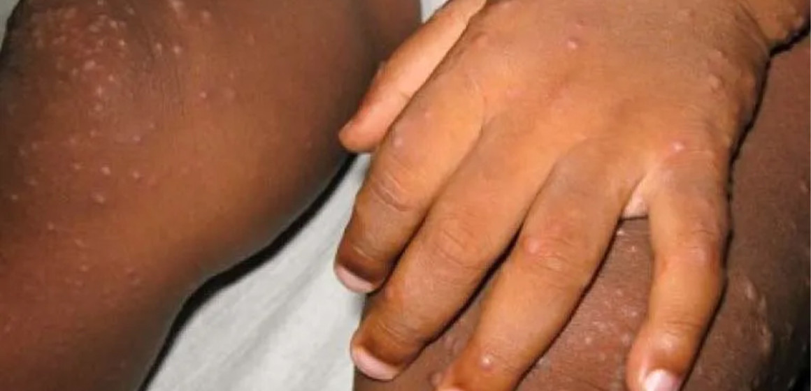 varicelle Enfant souffrant de varicelle