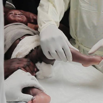 Hope Walks soigne le pied bot à Goma