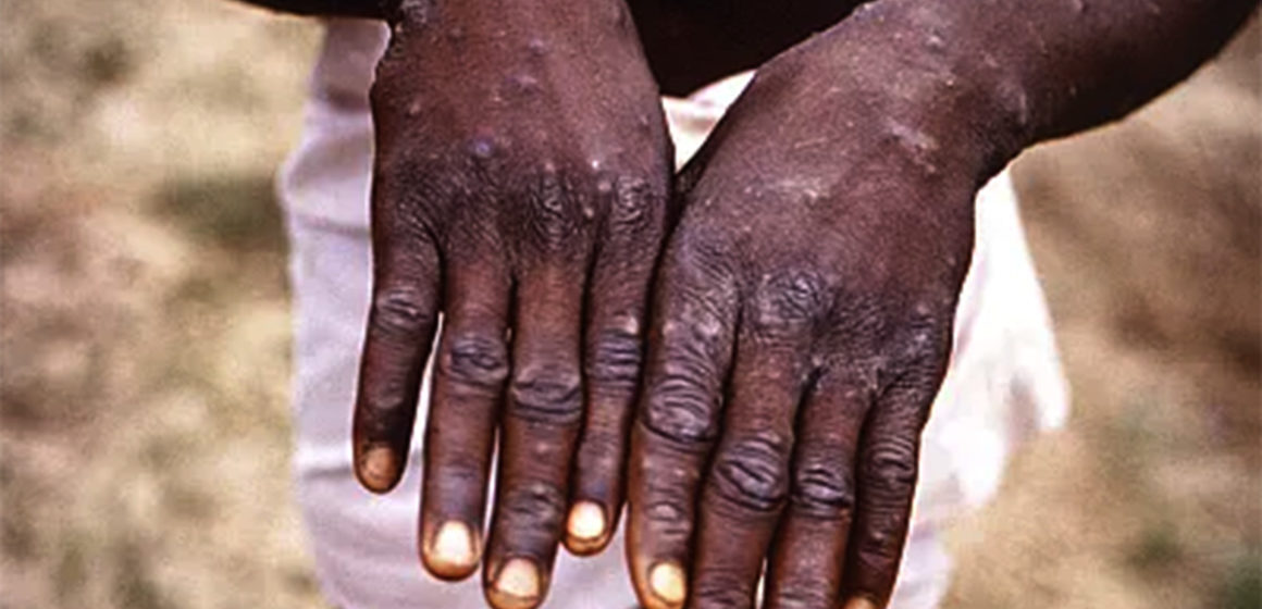 monkeypox3 Monkeypox