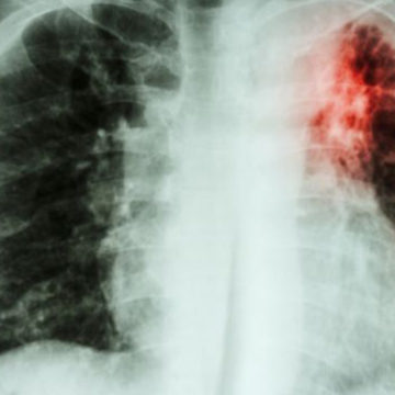 Ituri : La tuberculose progresse à cause des milices qui détruisent les structures sanitaires