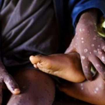 Monkeypox urgence sanitaire